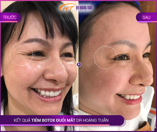 Kết quả tiêm botox đuôi mắt tại Thẩm mỹ Hoàng Tuấn