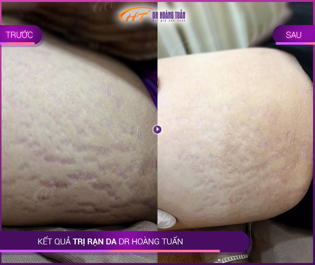 Kết quả trị rạn da tại Thẩm mỹ Hoàng Tuấn