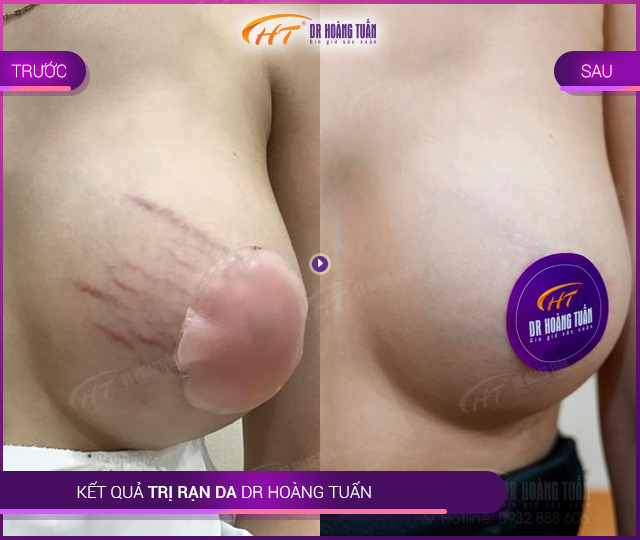 Kết quả trị rạn da tại Thẩm mỹ Hoàng Tuấn