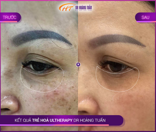 Kết quả Trẻ hoá da Ultherapy bọng mắt tại Thẩm mỹ Hoàng Tuấn