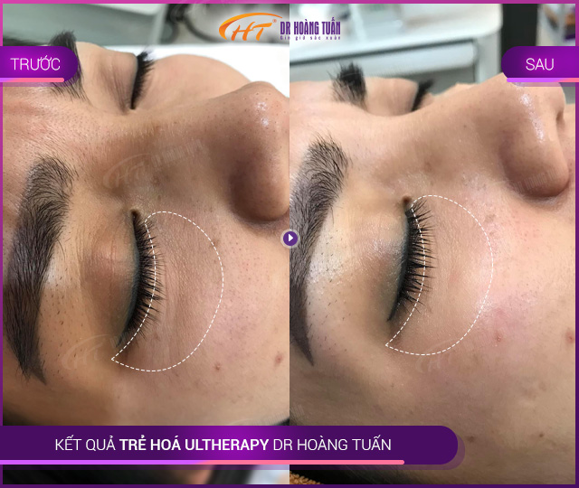 Kết quả dùng Ultherapy cho bọng mắt tại Thẩm mỹ Hoàng Tuấn