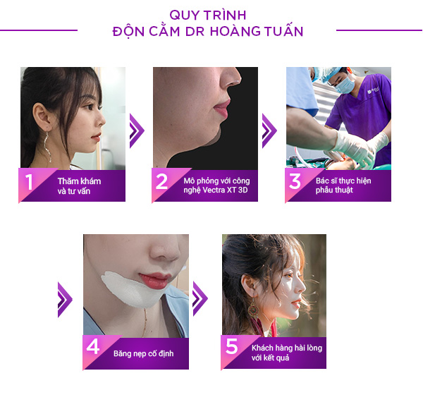 Độn cằm V-line hay độn cằm Hàn Quốc tại Dr Hoàng Tuấn là lựa chọn tối ưu giúp khách hàng khắc phục những khuyết điểm của cằm như cằm ngắn, lệch, cằm thô... và sở hữu cho mình gương mặt V-line, cân đối. 