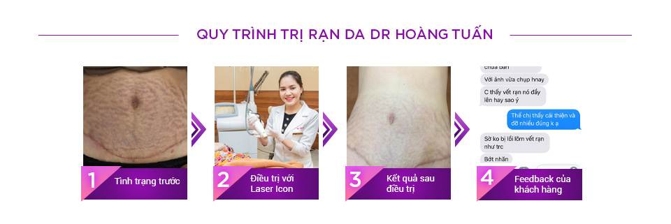 Quy trình điều trị rạn da tại Thẩm mỹ Hoàng Tuấn