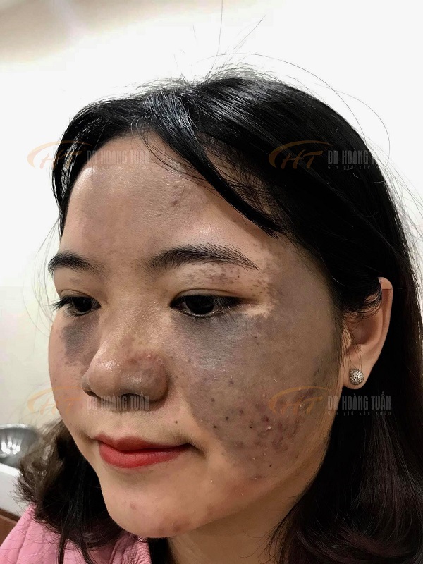 Hình ảnh một khách hàng bị chàm bẩm sinh đến điều trị tại Thẩm mỹ Hoàng Tuấn