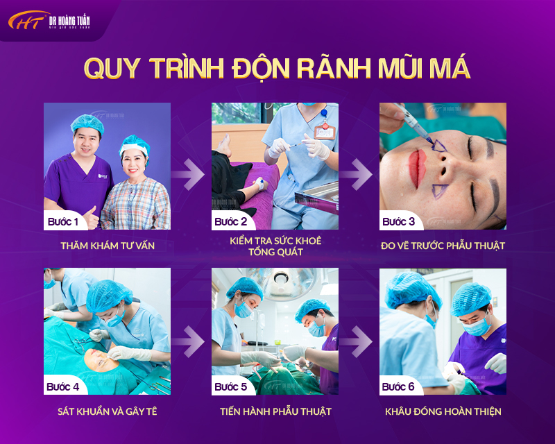Quy trình độn rãnh mũi má tại Dr Hoàng Tuấn