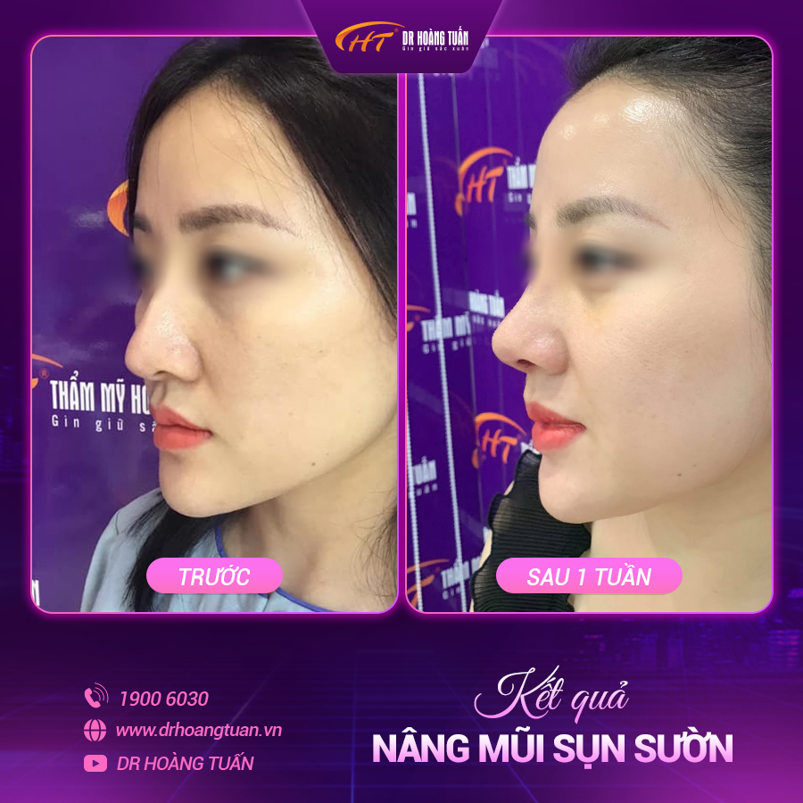 Kết quả nâng mũi sụn sườn tại Dr Hoàng Tuấn